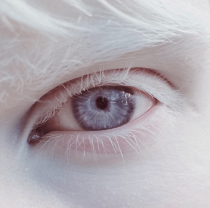 Albinizm - Oczy
