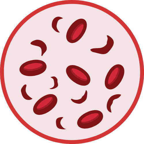 Anemia sierpowata