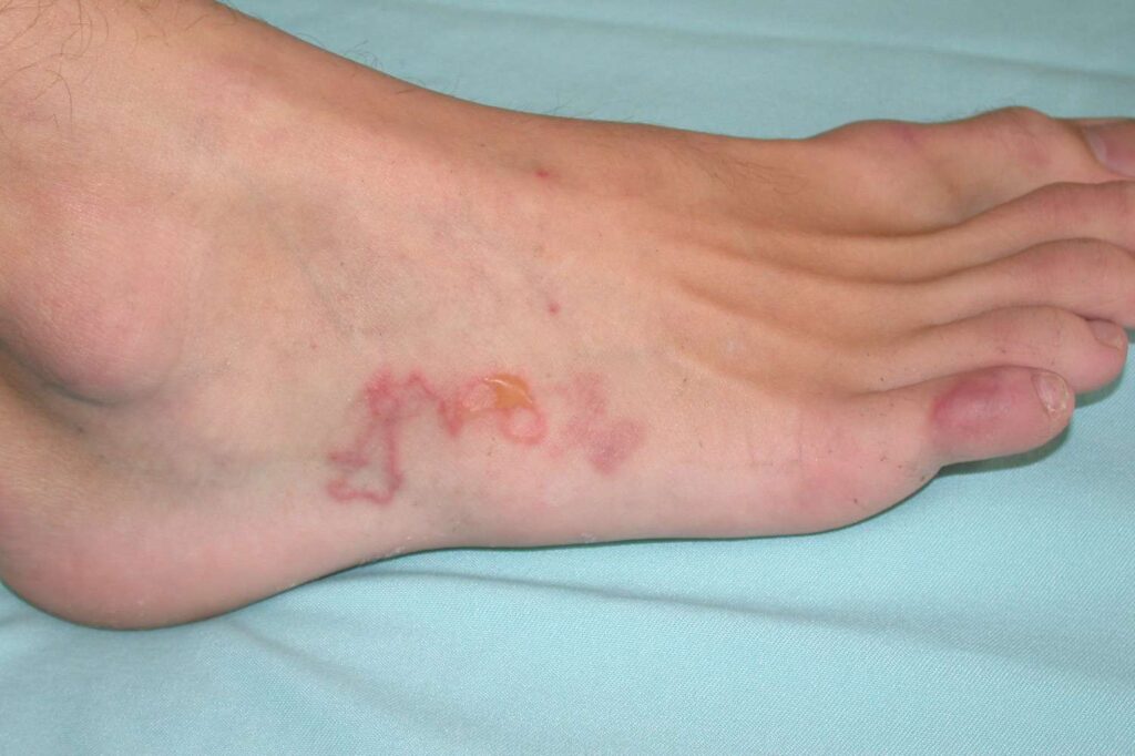 Ankylostomoza - larwa dostaje się przez stopy