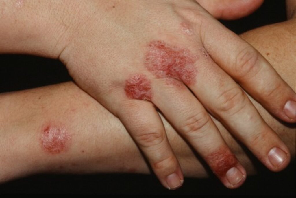 Bartoneloza - problemy dermatologiczne