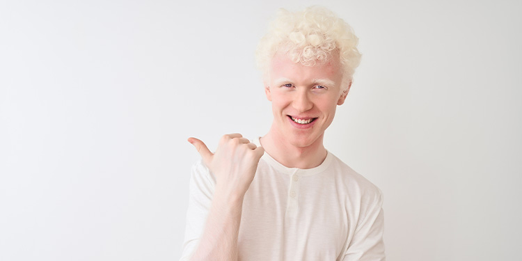 Albinizm