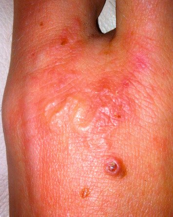 Ankylostomoza - zapalenie skóry