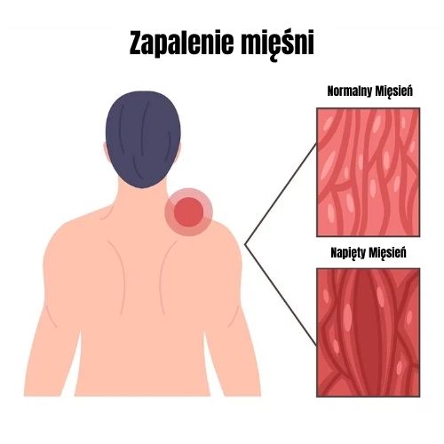 Zapalenie Mięśni