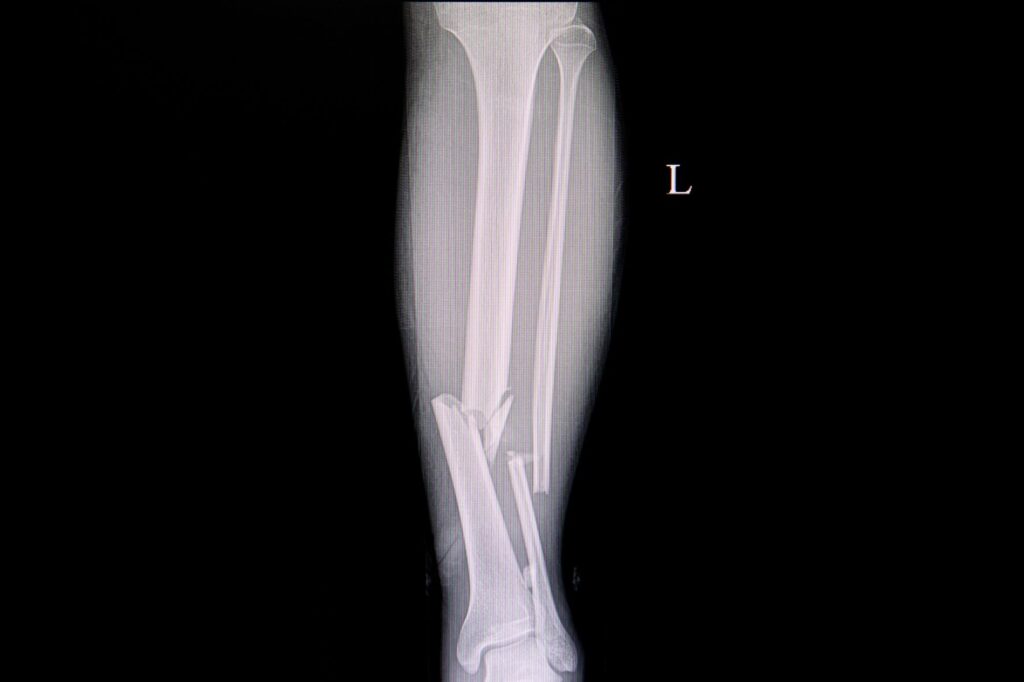 Złamania kości nogi