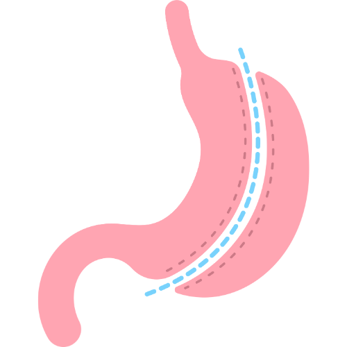 Gastrektomia