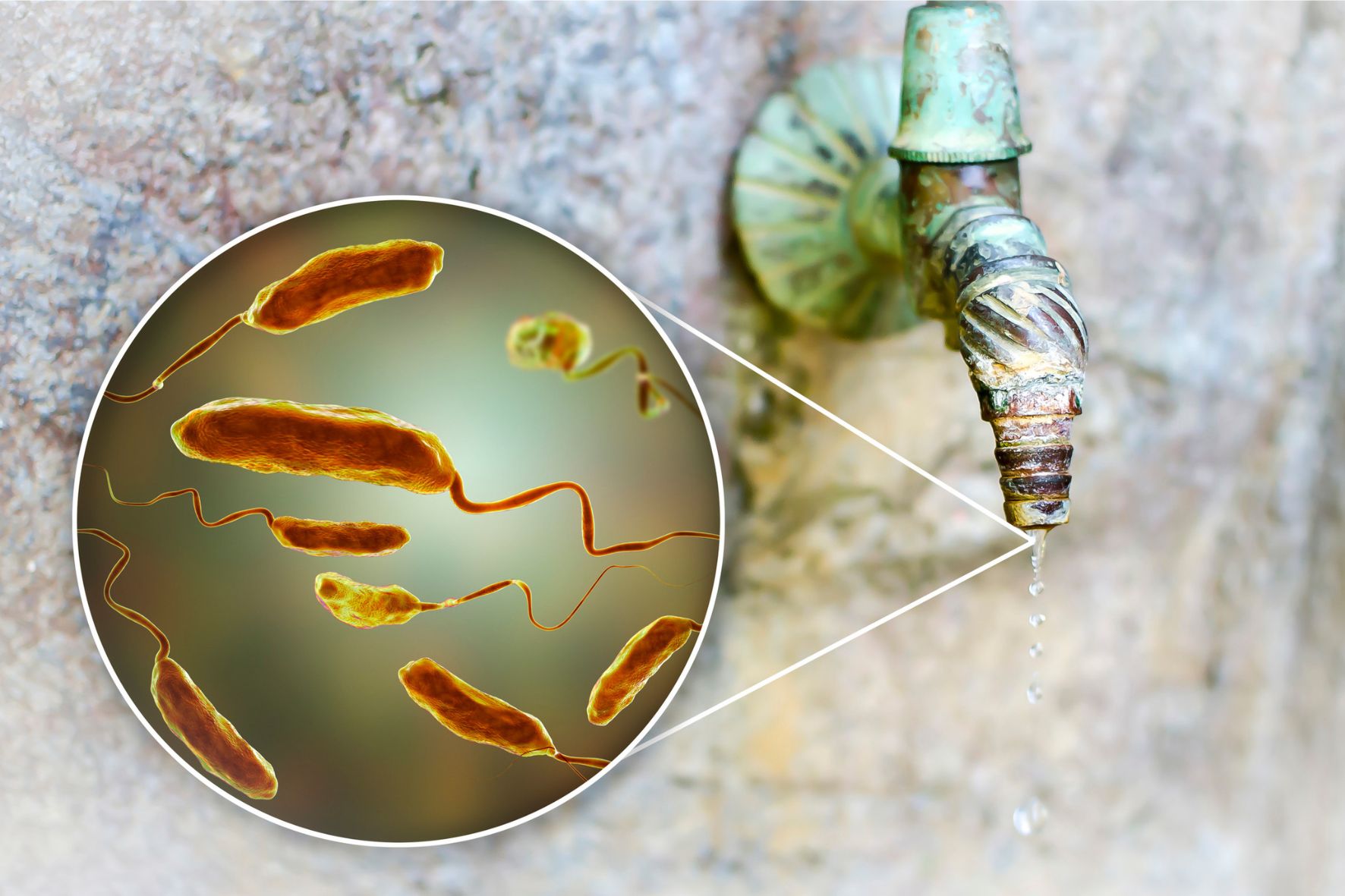 Cholera: Kompleksowy Przewodnik po Przyczynach, Objawach i Leczeniu