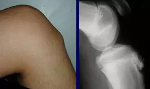 Choroba Osgood-Schlattera