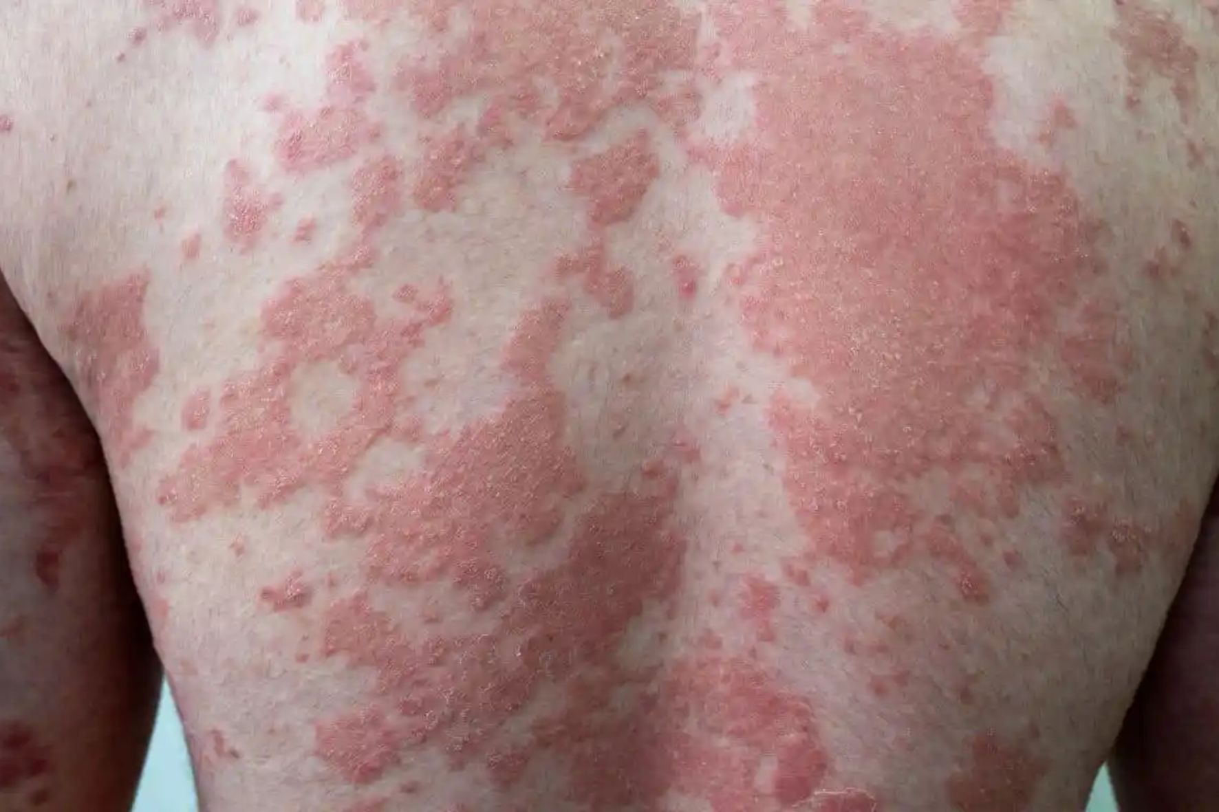 Erytrodermia: Kompleksowy Przewodnik
