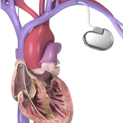 Wszczepialne defibrylatory (ICD)