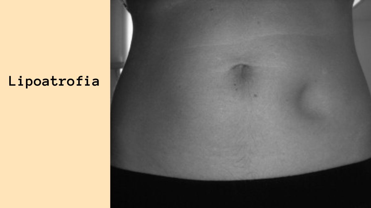 Lipoatrofia – Przyczyny, Diagnostyka i Leczenie