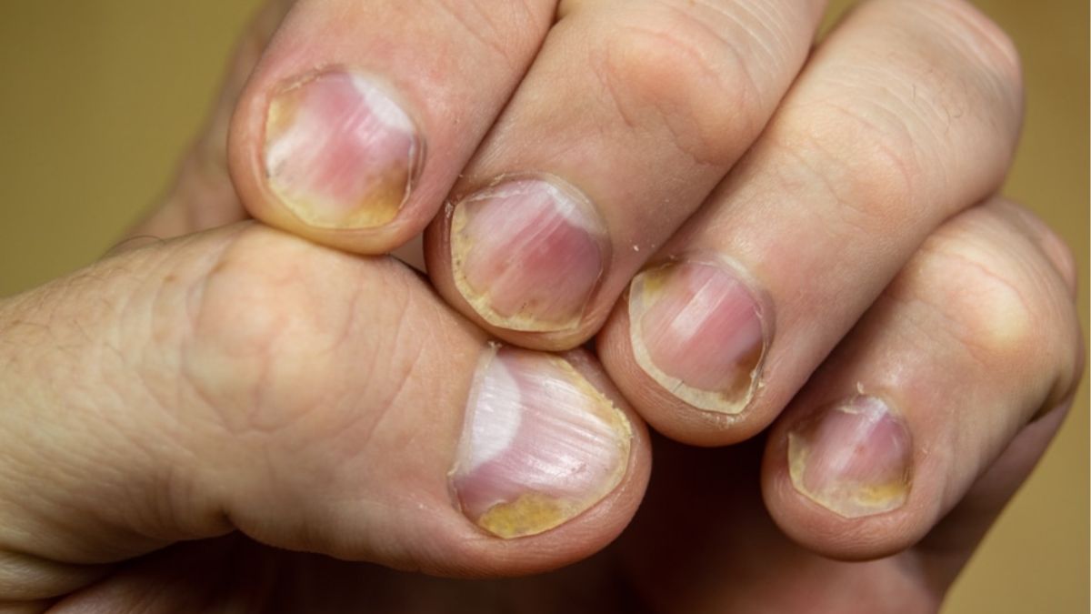 Łuszczyca paznokci – Diagnoza, Leczenie i Pielęgnacja