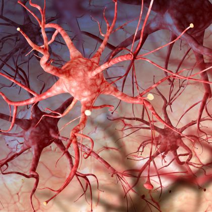 Neurofibromatoza