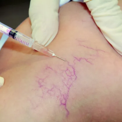 Skleroterapia