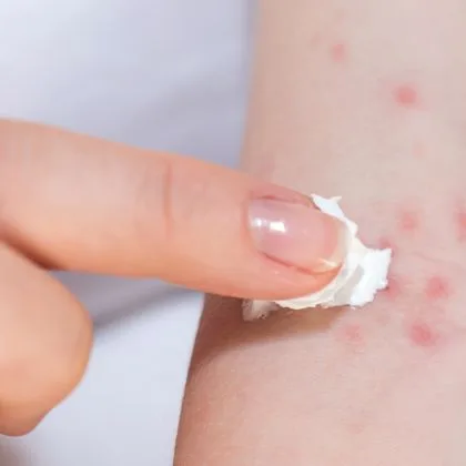 Alergiczne reakcje skórne