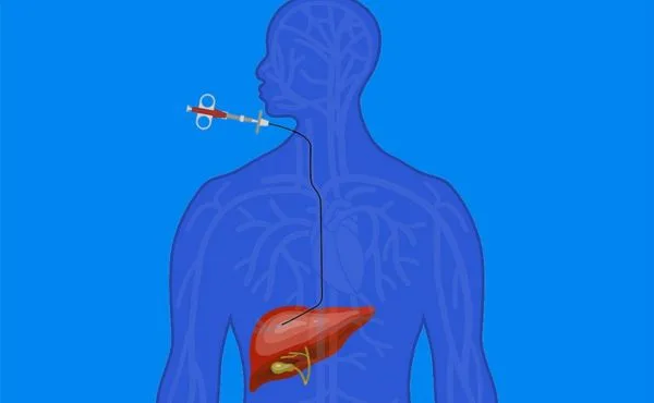 Biopsja wątroby