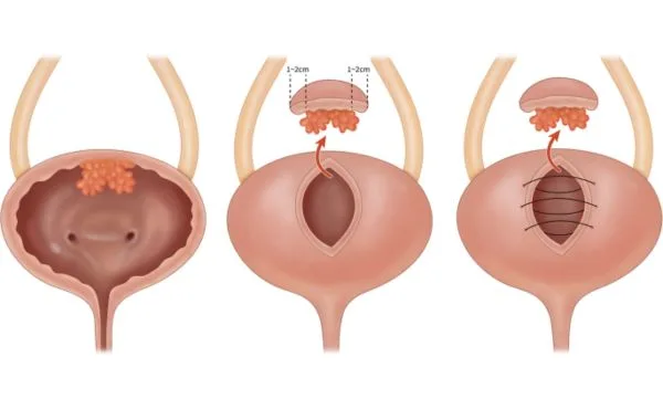 Cystektomia