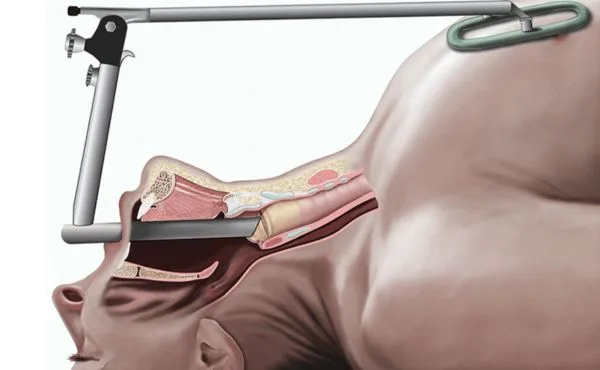 Laryngoskopia