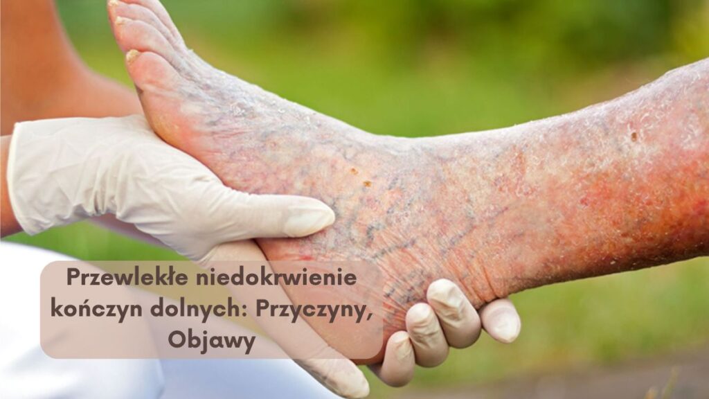 Przewlekłe niedokrwienie kończyn dolnych: Przyczyny, Objawy