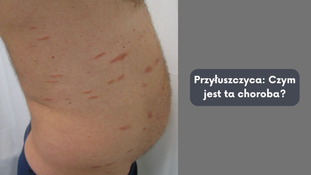 Przyłuszczyca: Czym jest ta choroba?