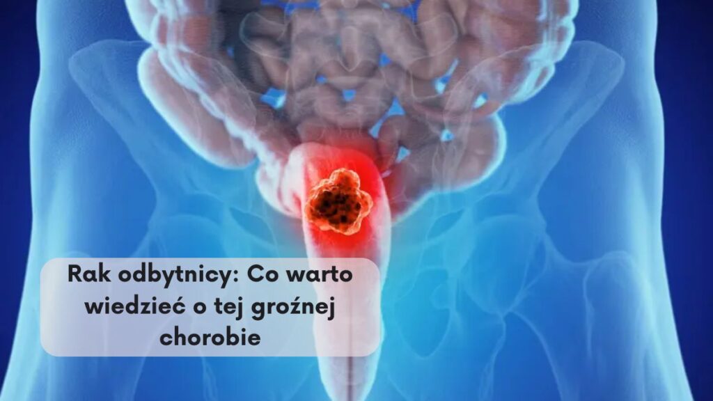 Rak odbytnicy: Co warto wiedzieć o tej groźnej chorobie