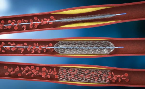 Angioplastyka
