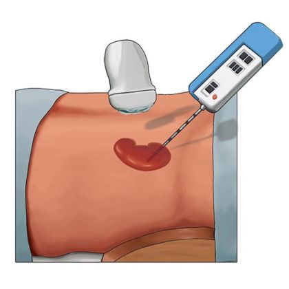 Biopsja nerki