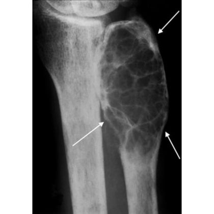 Osteodystrofia nerkowa
