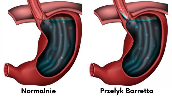 Przełyk Barretta