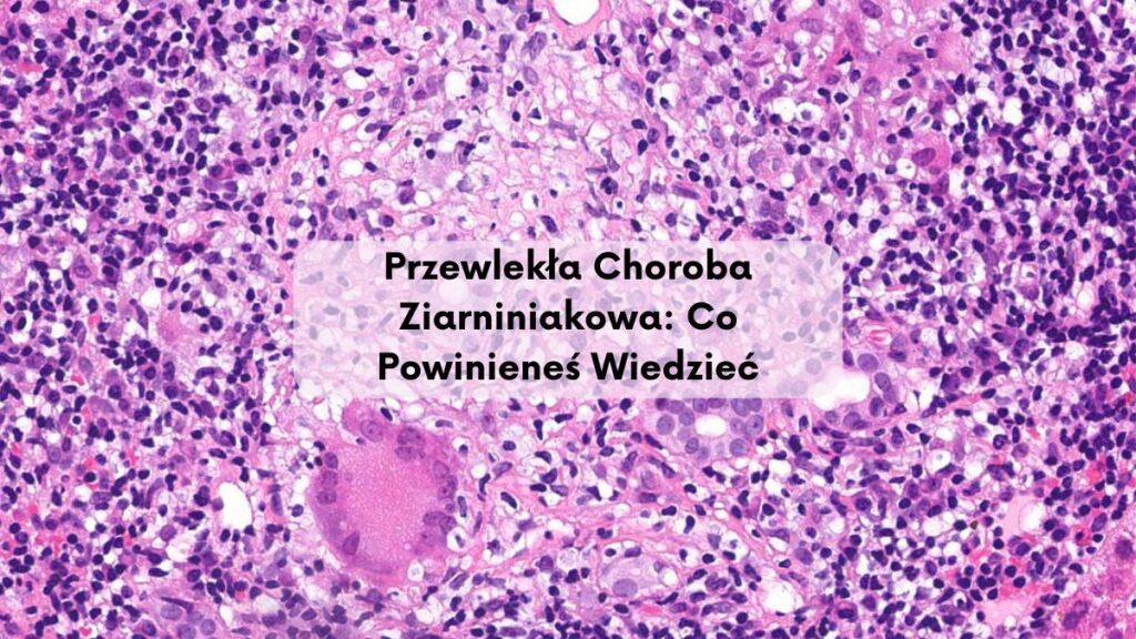 Przewlekła Choroba Ziarniniakowa: Co Powinieneś Wiedzieć