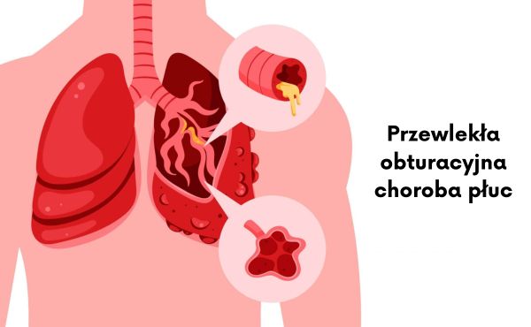 Przewlekła obturacyjna choroba płuc