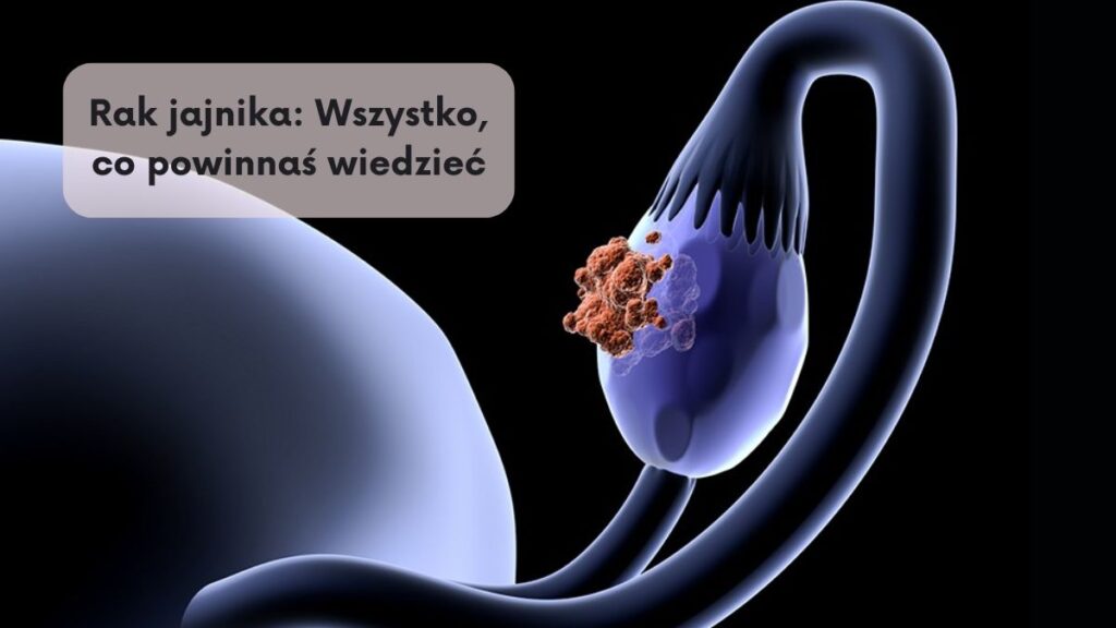 Rak jajnika: Wszystko, co powinnaś wiedzieć