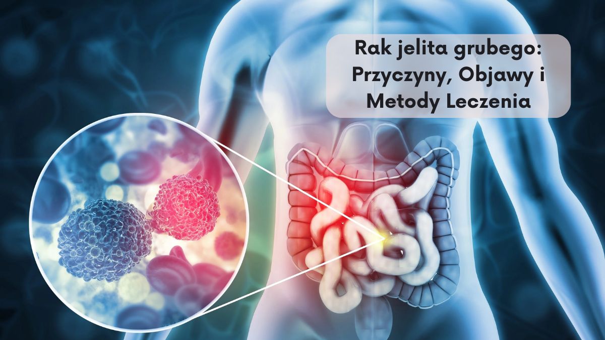 Rak jelita grubego: Przyczyny, Objawy i Metody Leczenia