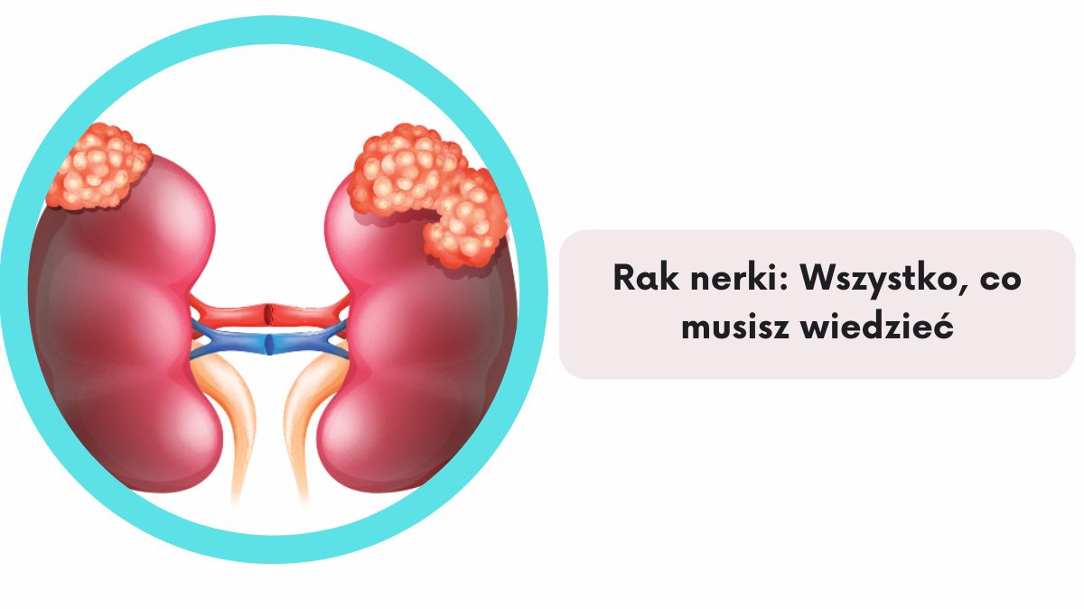 Rak nerki: Wszystko, co musisz wiedzieć