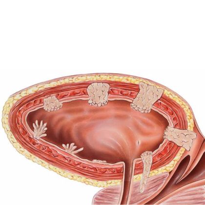 Rak pęcherza moczowego