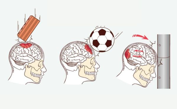 urazy czaszkowo-mózgowe
