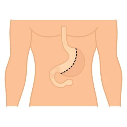 Gastrektomia