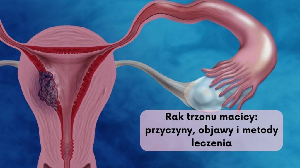 Rak trzonu macicy: przyczyny, objawy i metody leczenia