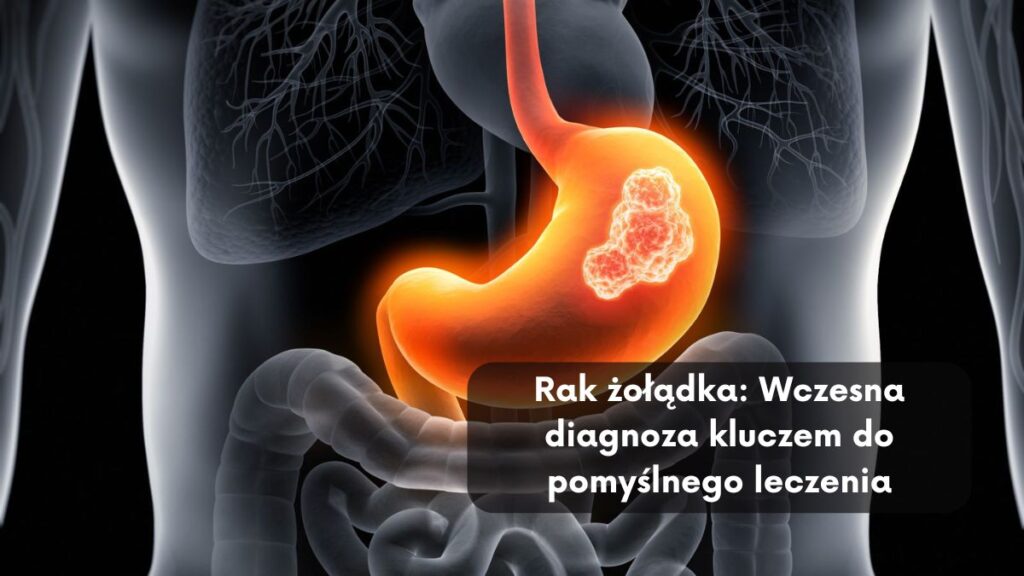 Rak żołądka: Wczesna diagnoza kluczem do pomyślnego leczenia