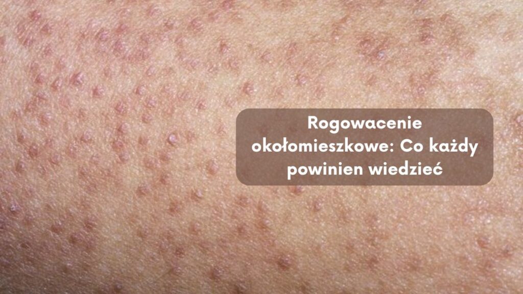 Rogowacenie okołomieszkowe: Co każdy powinien wiedzieć