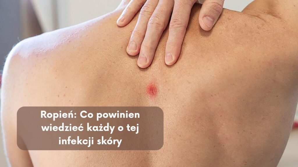 Ropień: Co powinien wiedzieć każdy o tej infekcji skóry