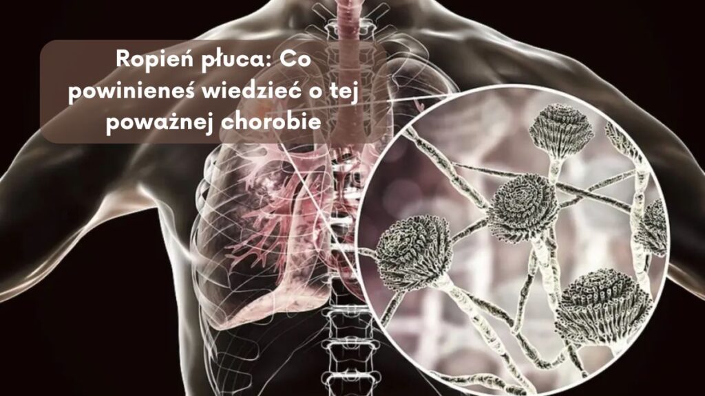 Ropień płuca: Co powinieneś wiedzieć o tej poważnej chorobie