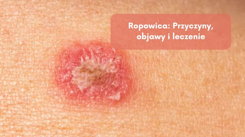 Ropowica: Przyczyny, objawy i leczenie