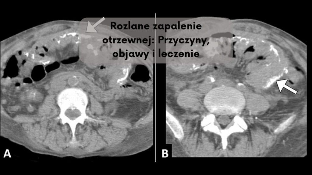 Rozlane zapalenie otrzewnej: Przyczyny, objawy i leczenie