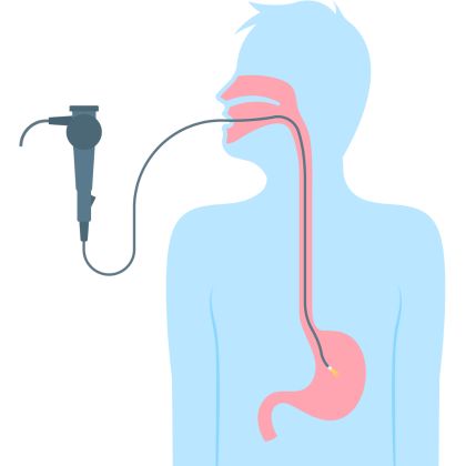 Endoskopia przełyku