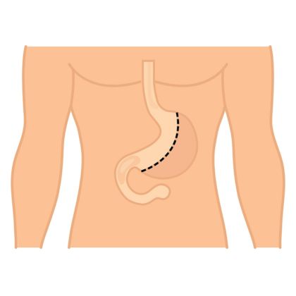 Gastrektomia