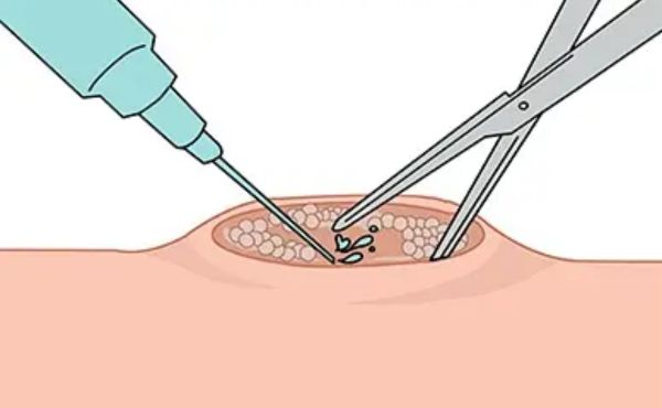 Nacięcie i drenaż ropnia