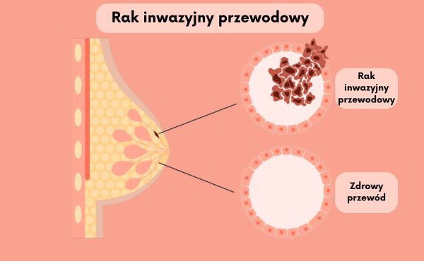 Rak inwazyjny przewodowy