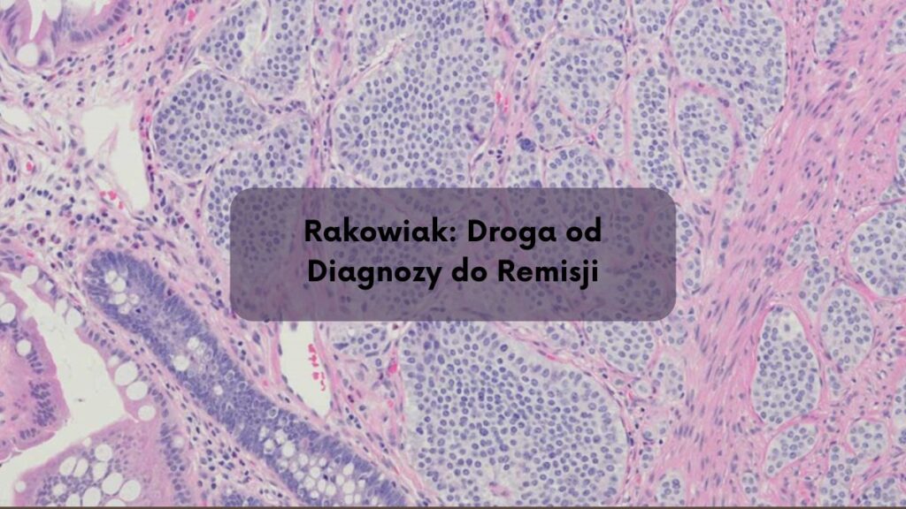 Rakowiak: Droga od Diagnozy do Remisji