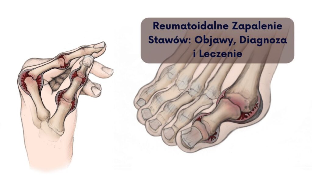 Reumatoidalne Zapalenie Stawów: Objawy, Diagnoza i Leczenie