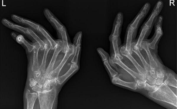 rentgen stawów Reumatoidalne Zapalenie Stawów